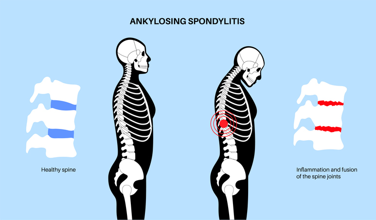 Rheumatoid arthritis functional medicine – Dr. Jamie Ahn ND, Norwalk CT