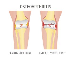 Illustration comparing a healthy knee joint and osteoarthritis with damaged cartilage.